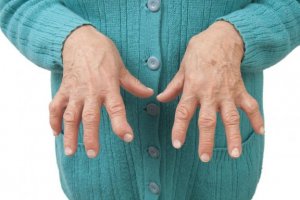 Romatoid Artriti Bu Tıbbi Reçetelerle Rahatlatın