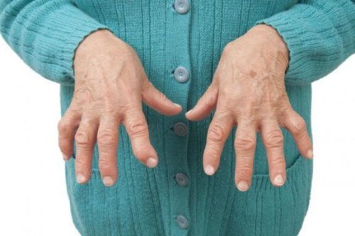 Romatoid Artriti Bu Tıbbi Reçetelerle Rahatlatın