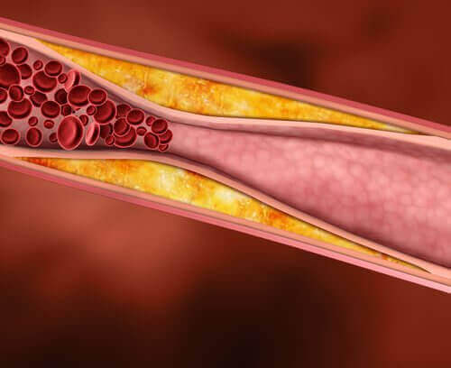 kolesterolden tıkalı damar