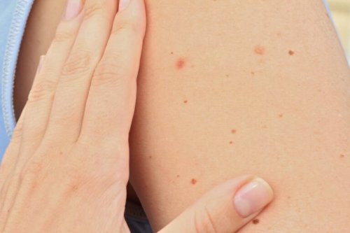 kolunda kırmızı ben olan insan