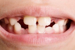 Diş Agenezisi: Türleri ve Tedavileri