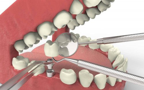 diş implantı