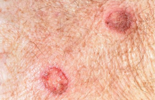 iki benzer cilt lekesi ve cilt lekeleri