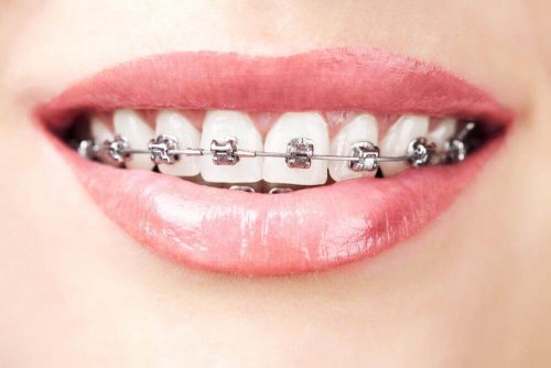 ortodonti tedavisi gören kadın