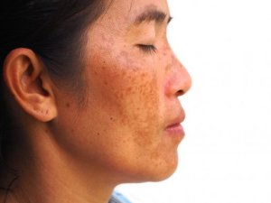 Yoğurt, Muz ve Limon İle Melasma Tedavisi