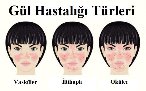 gül hastalığı türleri