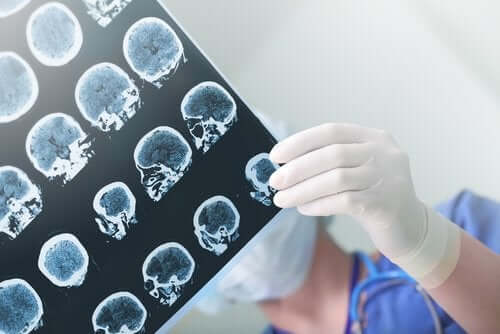 alzheimer