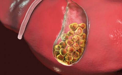 safra kesesi taşları