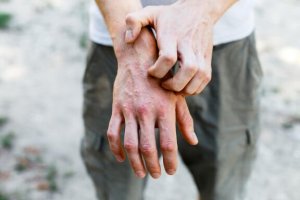 Kontakt Dermatit Tedavisinde 6 Doğal İlaç