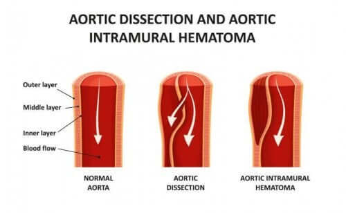 aort diseksiyonu
