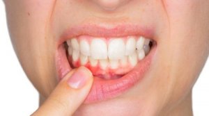 Diş Apsesi Nasıl Tedavi Edilir