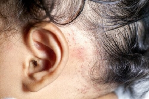 Sedef hastalığı olan bir bebek.