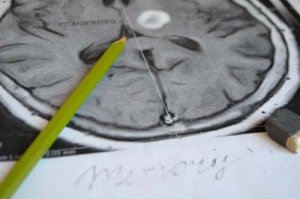 Hafıza Kaybı Belirtileri ve Hafıza Kaybının Önlenmesi