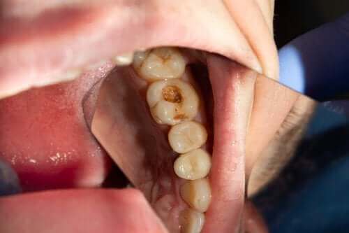 Çürük Dişler: Dişlerin Çürümesine Neden Olan Şey Nedir?