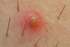 Kıl Dönmesi Nasıl Önlenir?