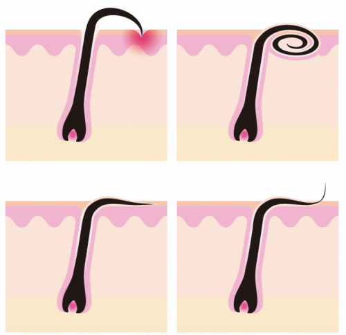 Kıl kökü çeşitleri