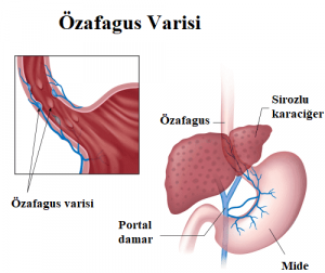 Özafagus Varisi İşaretleri ve Semptomları