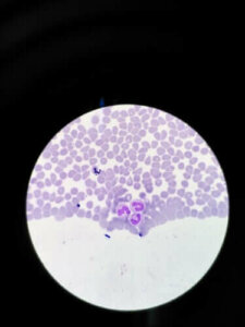 Agranülositoz: Semptomları Ve Tedavileri