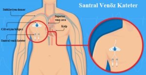 Vasküler Perforasyon ve Santral Venöz Kateterler