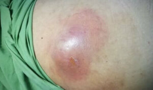 Karın İçi Apseler Nelerdir?