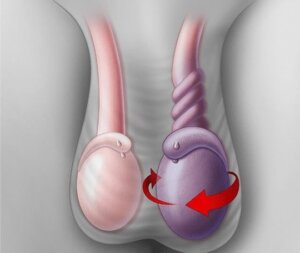 Testis Torsiyonu: Belirti ve Nedenleri