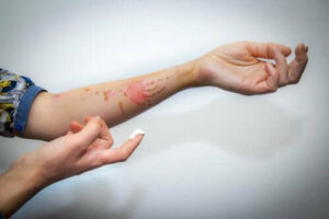 Yüzeysel Yanık Tedavisi