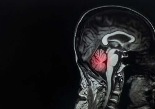 Beyin Metastazları: Tanım ve Tedavi