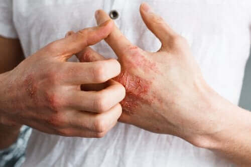 Atopik Dermatit Nedir?