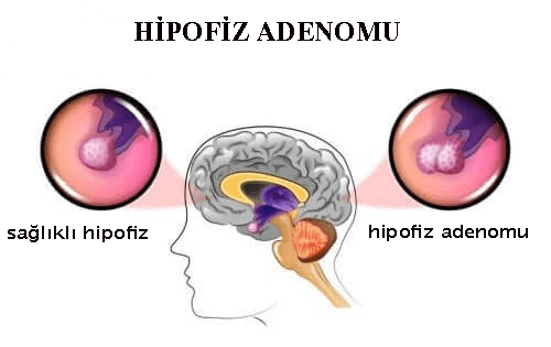Hipofiz Adenomları: Sebepleri ve Semptomları