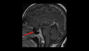 Hipofiz Adenomu Nedir?