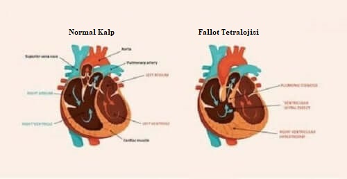 konjenital kalp hastalığı ve normal kalp