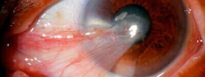 pterjium fotoğrafı