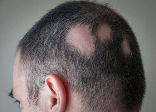 Saçkıran (alopesi) yaşayan bir adam.