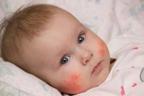 Perioral dermatit geçiren bebek