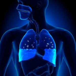 Akciğer Ödemi: Belirtileri ve Nedenleri