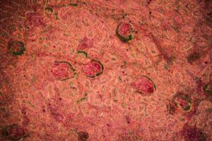 Böbrek Tüberkülozu: Tanı ve Tedavi