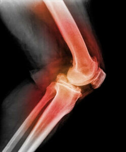 Diz Kapağı Çıkığı Hakkında Her Şey