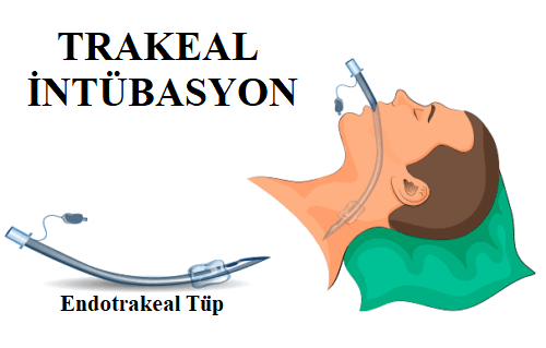 Endotrakeal tüpler nasıl uygulanır gösteren bir illüstrasyon.