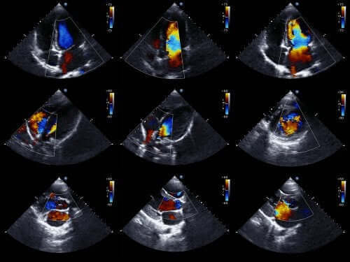kalp ultrasonu