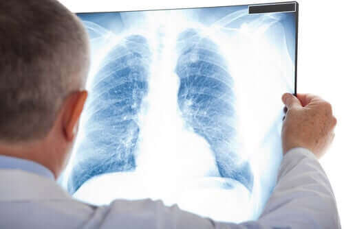 Bir akciğer röntgenine bakan bir doktor.