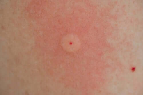 Bir insanın cildindeki arı sokması.