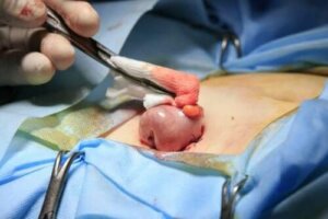 Kolostomi Nedir?