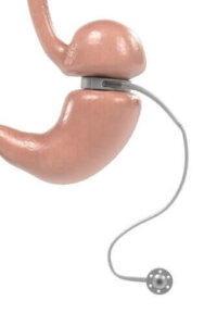 Ayarlanabilir Mide Kelepçesi: Kullanımı ve Özellikleri