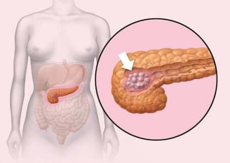 Pankreas tümörü