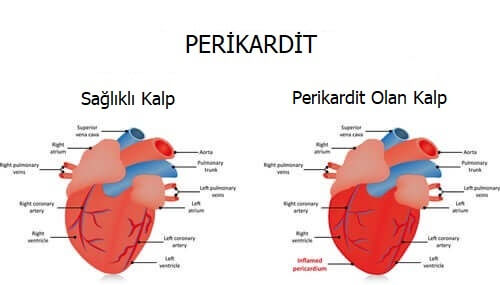 Kalp zarı iltihabı olan kalp ile sağlıklı kalp arasındaki farklar