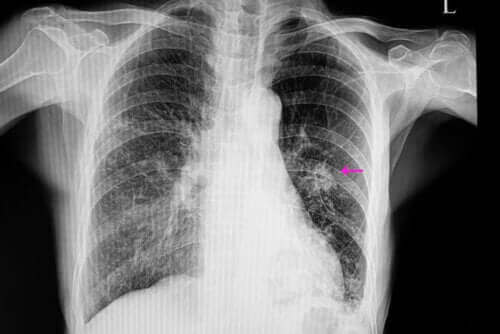 Akciğer Nodülü Tam Olarak Nedir?