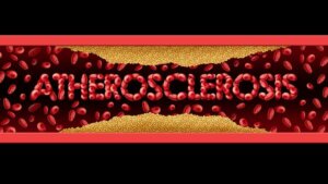 Ateroskleroz: Semptomları ve Tedavisi