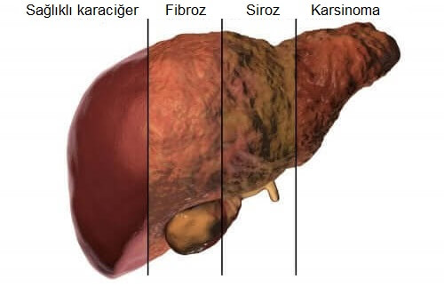 normal ve hasta karaciğer görseli