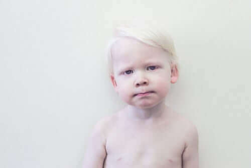 küçük çocuk albino
