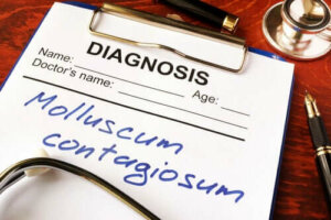 Molluskum Kontagiozum Hastalığı Nedir?